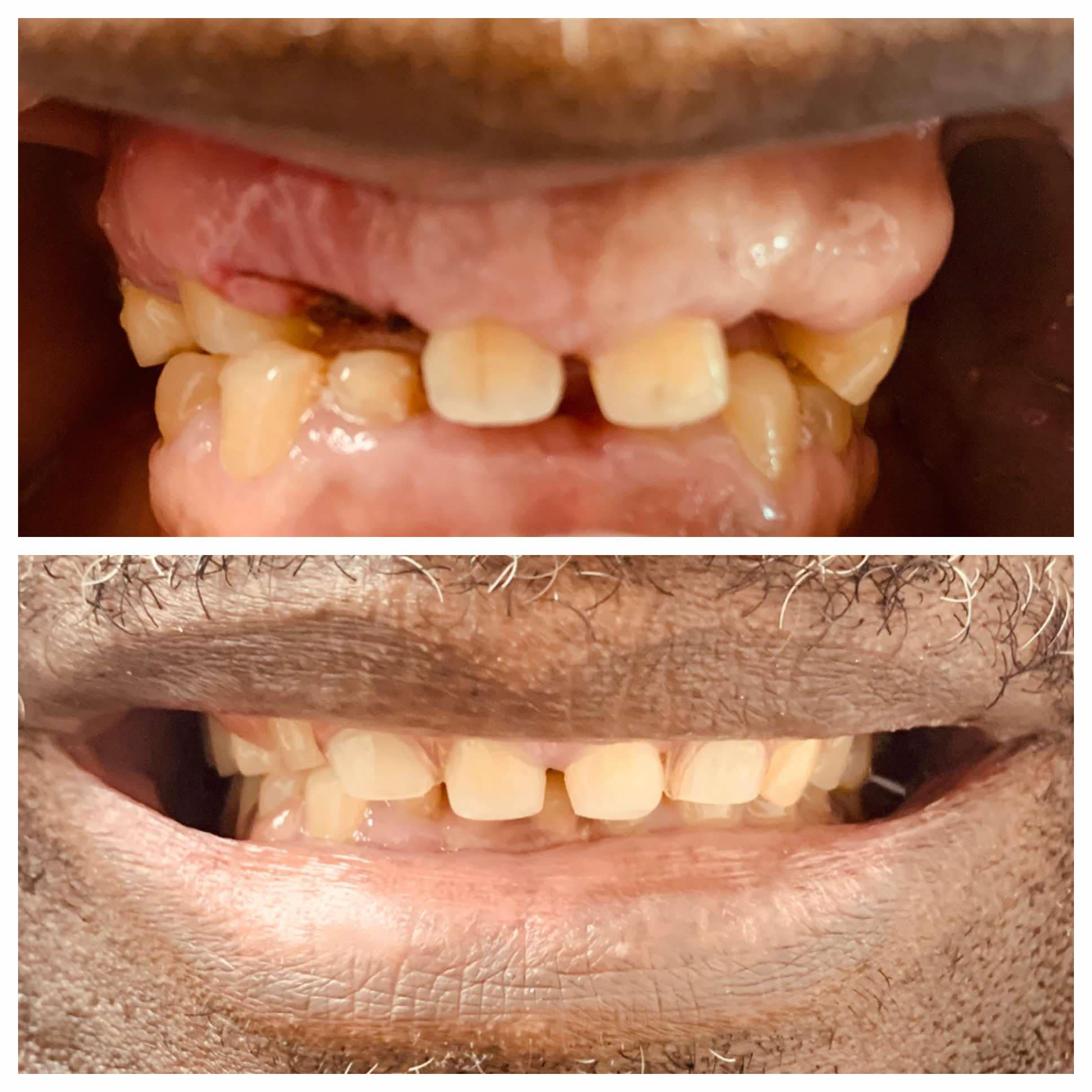 Before and after of a a denture in the patients mouth after being created at great smiles of buford center.