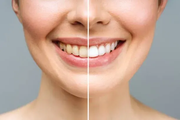Before and after smile showing porcelain veneer results at Great Smiles Buford Center in Buford GA